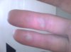 blisters!.jpg